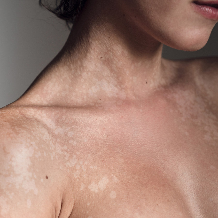 Pityriasis Versicolor: Causes, Treatment, and the Benefits of Ozonated Oil