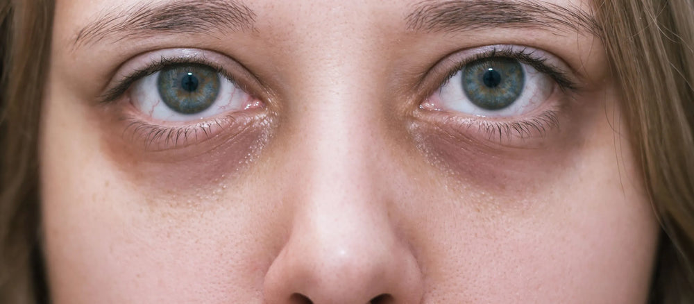 How To Use Ozonated Oils for Dark Circles Around Eyes?