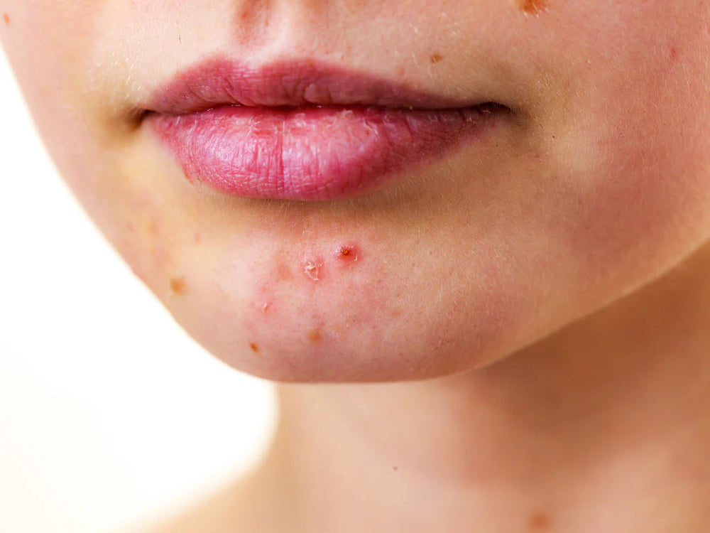 Perioral Dermatitis and Ozonated Oils: A Natural Treatment Option