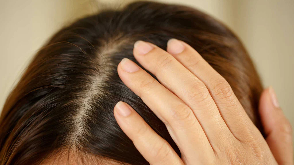 Dandruff, Scalp Psoriasis and Sebopsoriasis – A Guide of Management and Treatment with Ozonated Oils