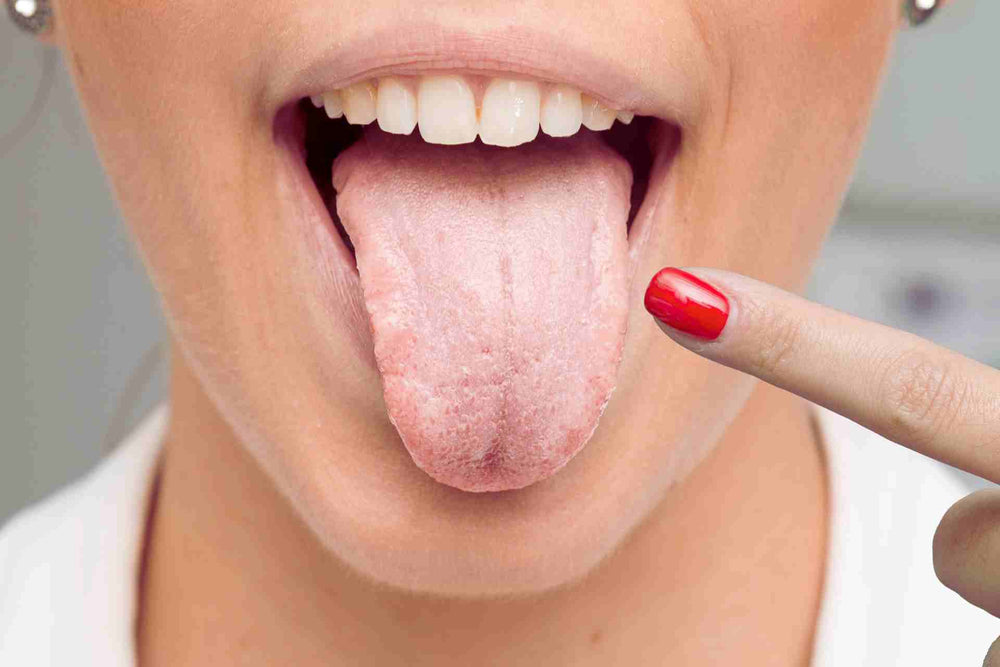 Combating Fungal Infections of the Tongue with Ozonated Oil