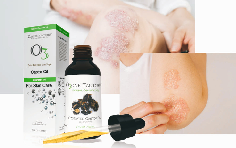 Can You Use Ozonated Castor Oil for Psoriasis?