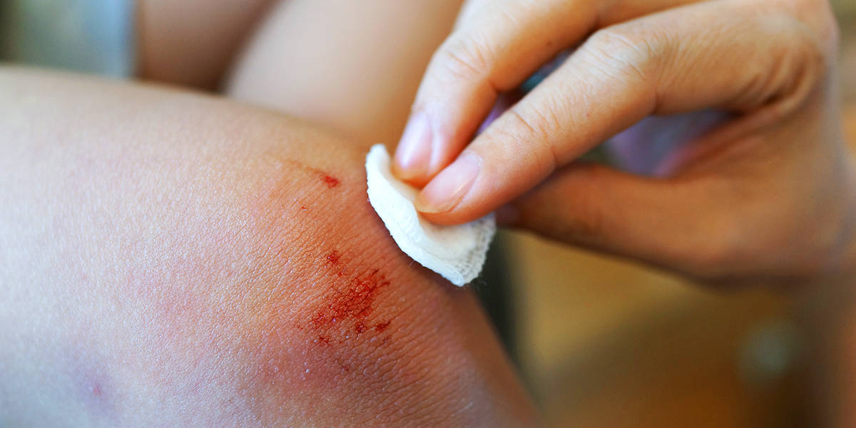 Natural First-Aid at Home: How Ozonated Oils Can Help