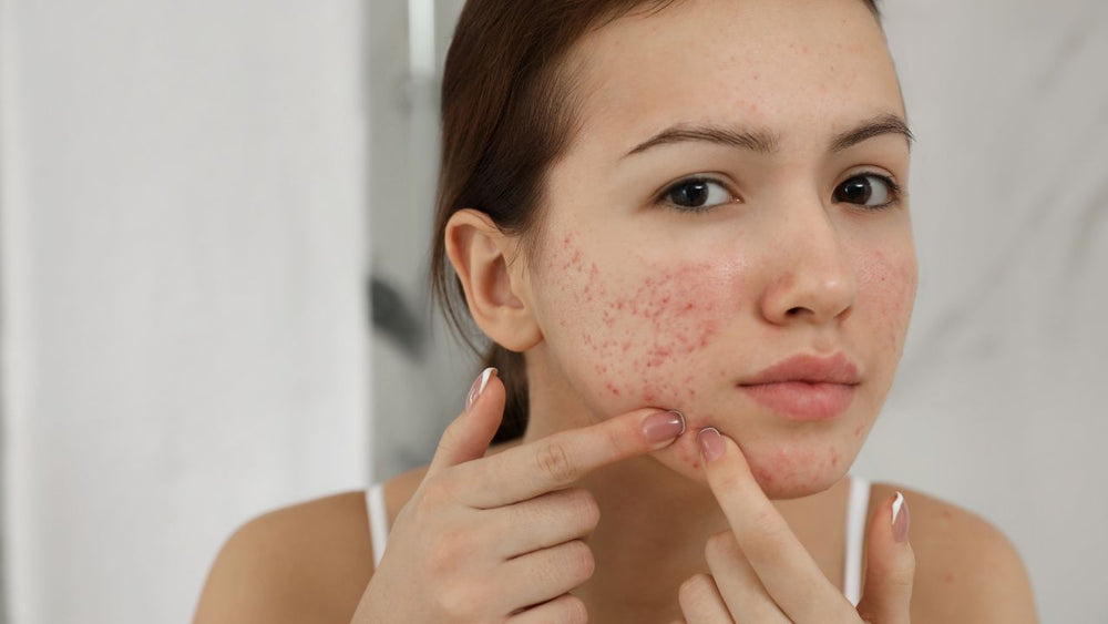 Common Mistakes to Avoid When Managing Acne: Expert Tips for Healthier Skin