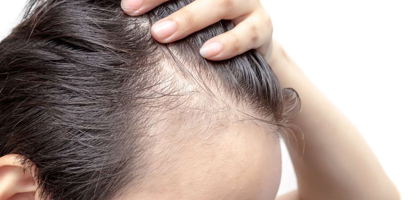 Alopecia: Understanding the Condition, Types, Treatment Options, and the Potential Benefits of Ozonotherapy and Ozonated Oils