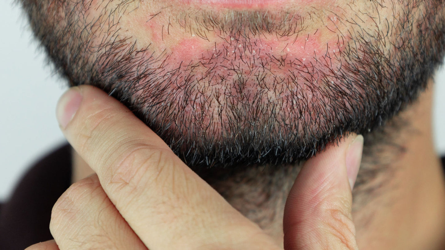 Beard Dandruff and the Role of Ozonated Oils in Scalp and Beard Care