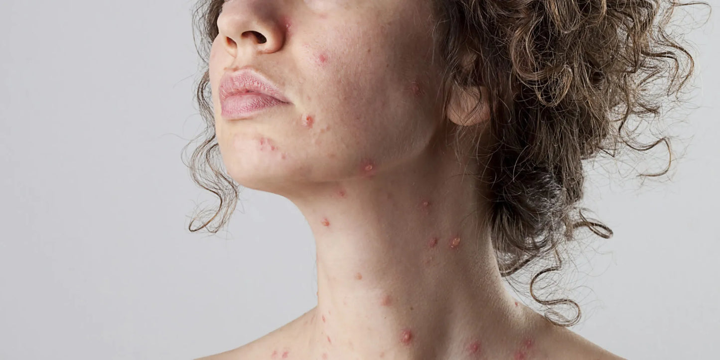 CHICKENPOX MARKS – NATURAL WAY to REMOVE THEM?
