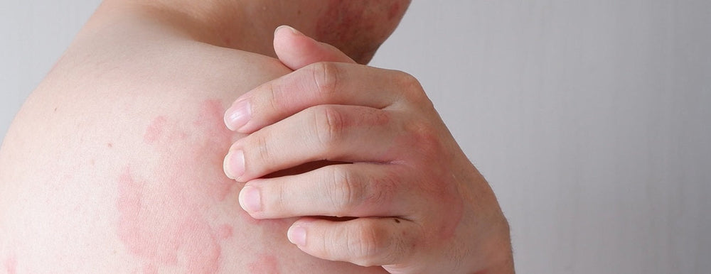 From Irritation to Recovery: Understanding Drug-Induced Skin Reactions and the Benefits of Ozonated Oils