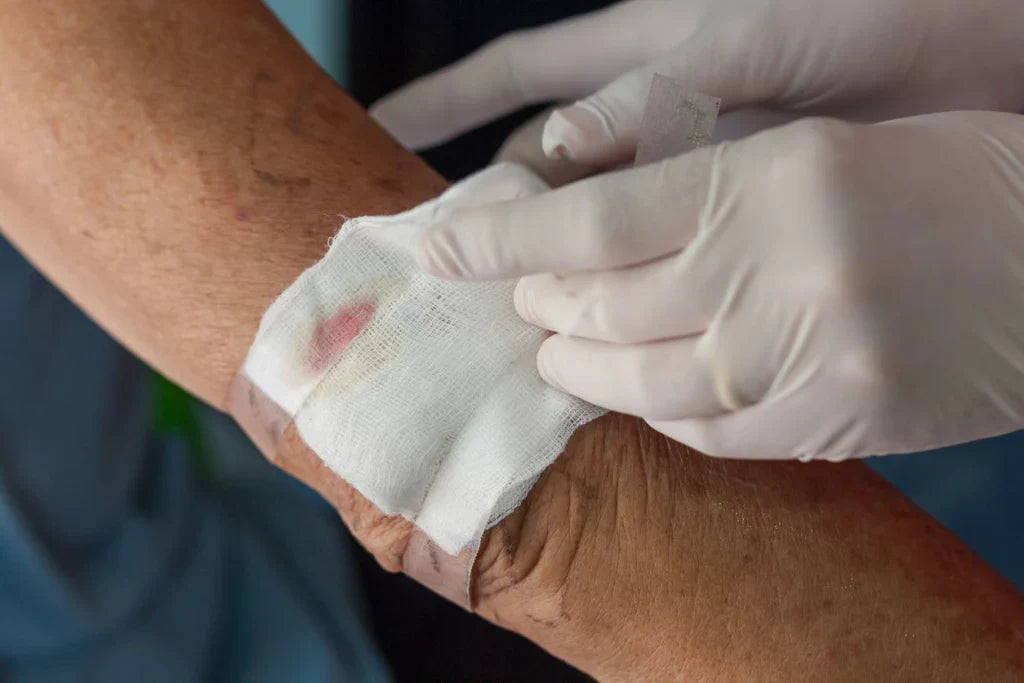Pressure Ulcers and the Role of Ozonated Oils in Skin Care